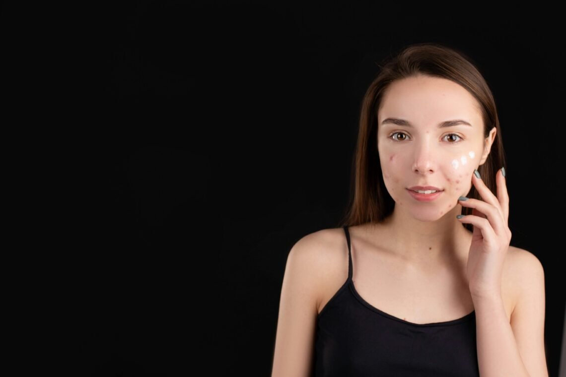 Smiling Teenager with Pimples Looking at Camera